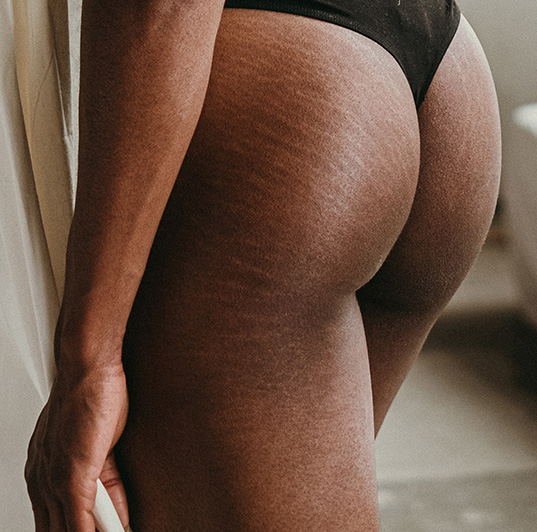 stretch marks on buttocks and thighs